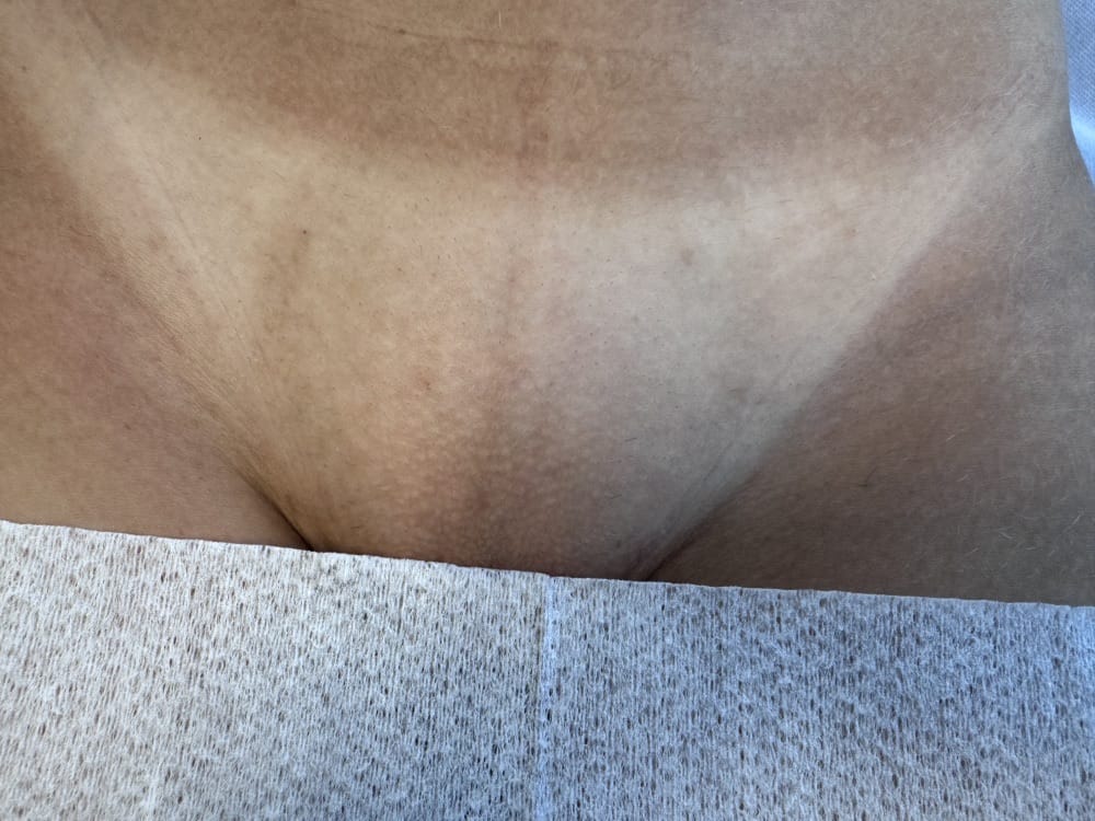 Efter 5 laserbehandlinger
