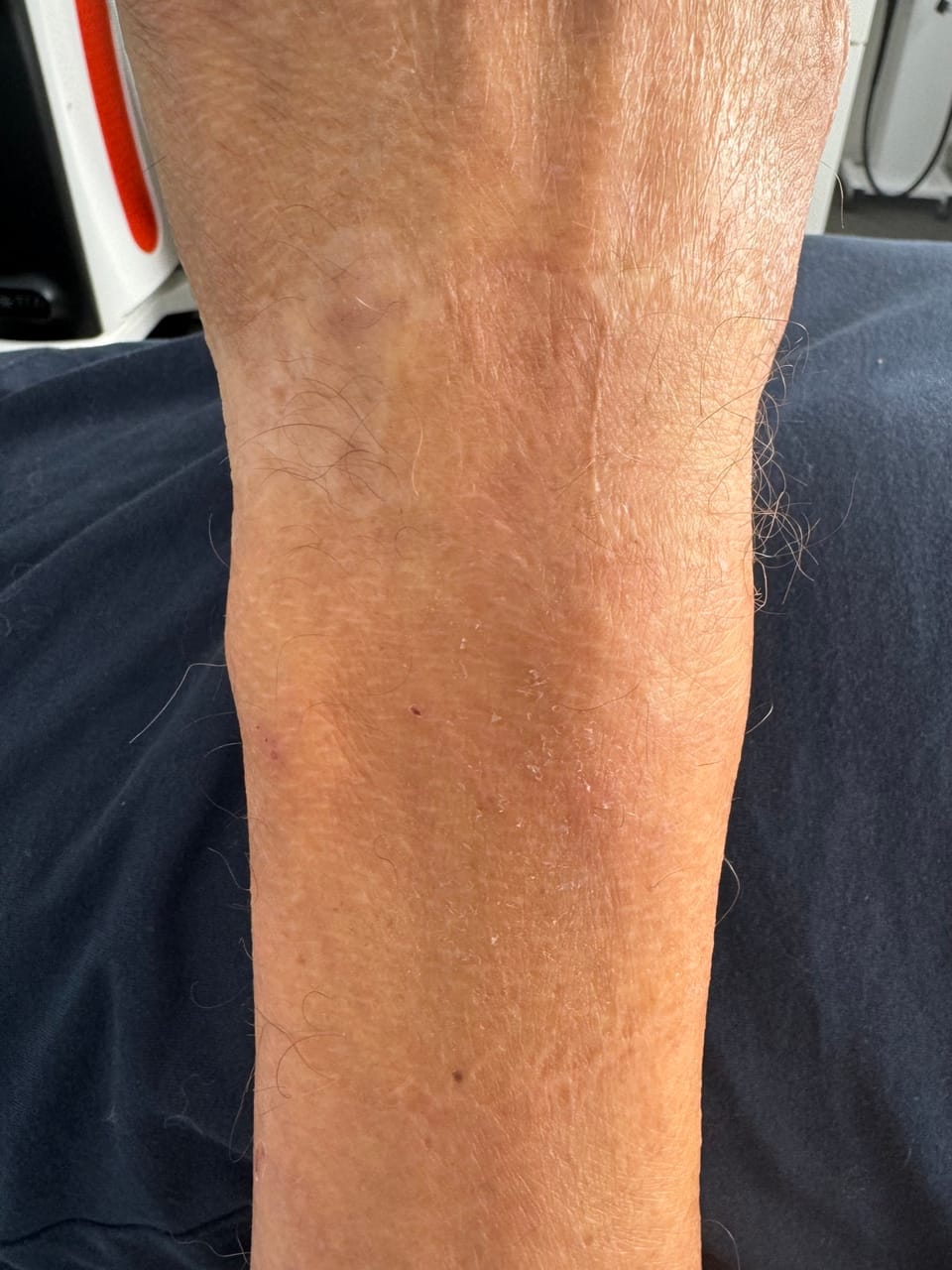 Efter SkinPen Microneedling-behandling af ar