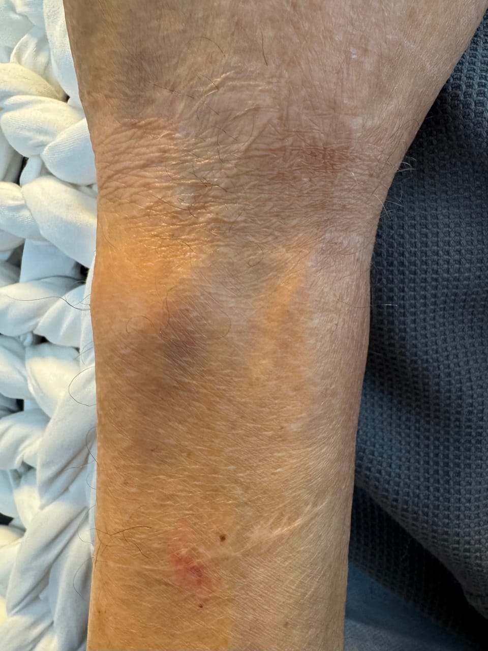Før SkinPen Microneedling-behandling af ar